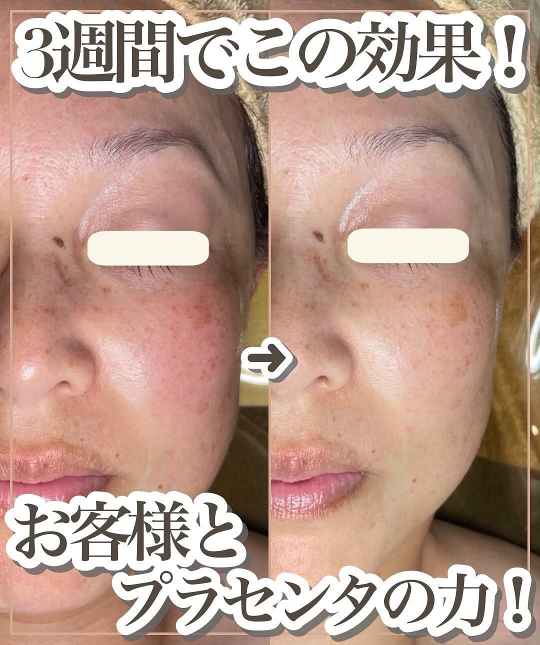3週間の集中ケアによるビフォーアフター。お客様の努力とプラセンタ美容液による改善効果を伝える肌変化の比較写真。