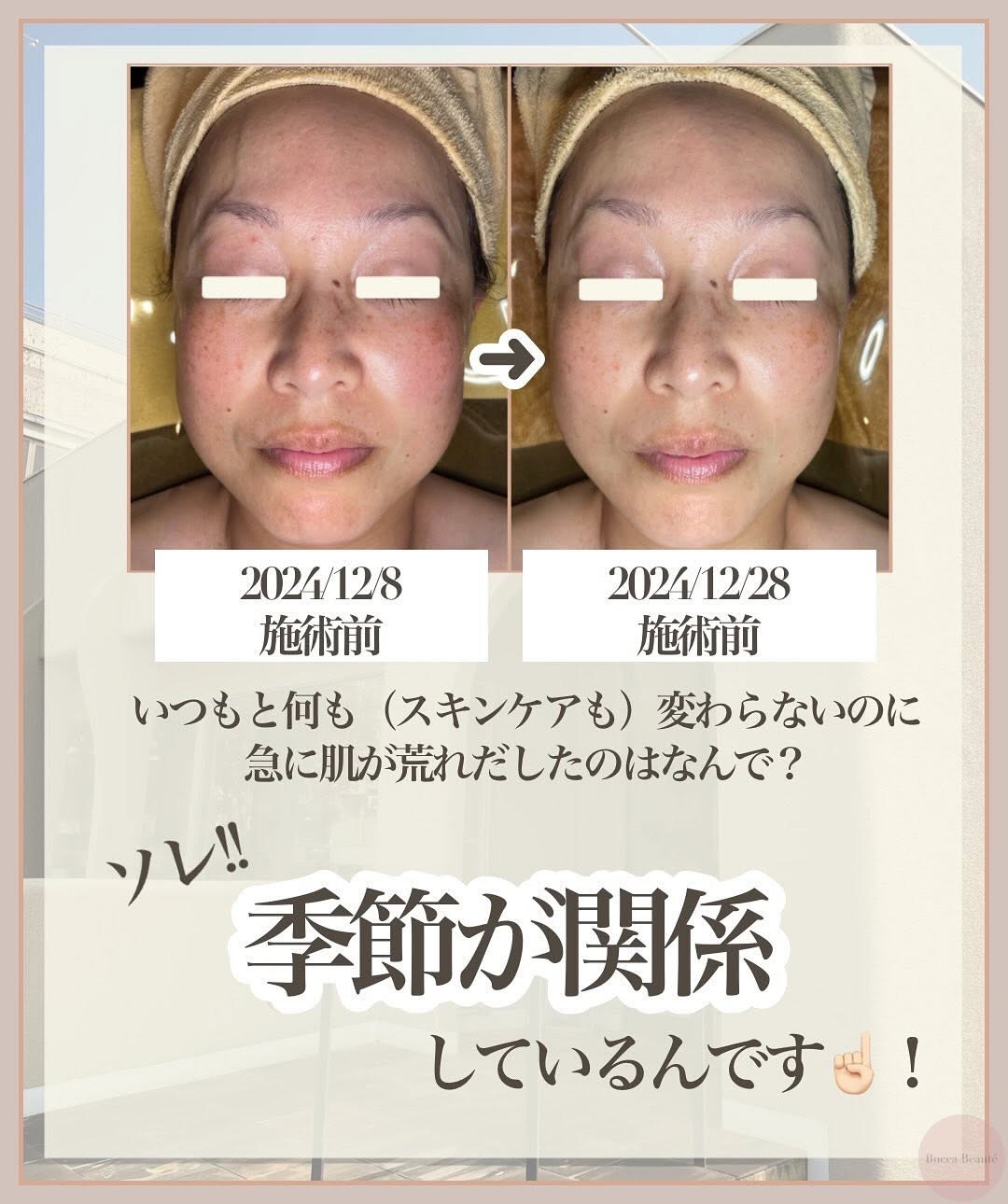 2024年12月8日と12月28日のビフォー比較画像。スキンケアを変えていないのに肌荒れが起きた原因は“季節の影響”というメッセージを伝える写真。