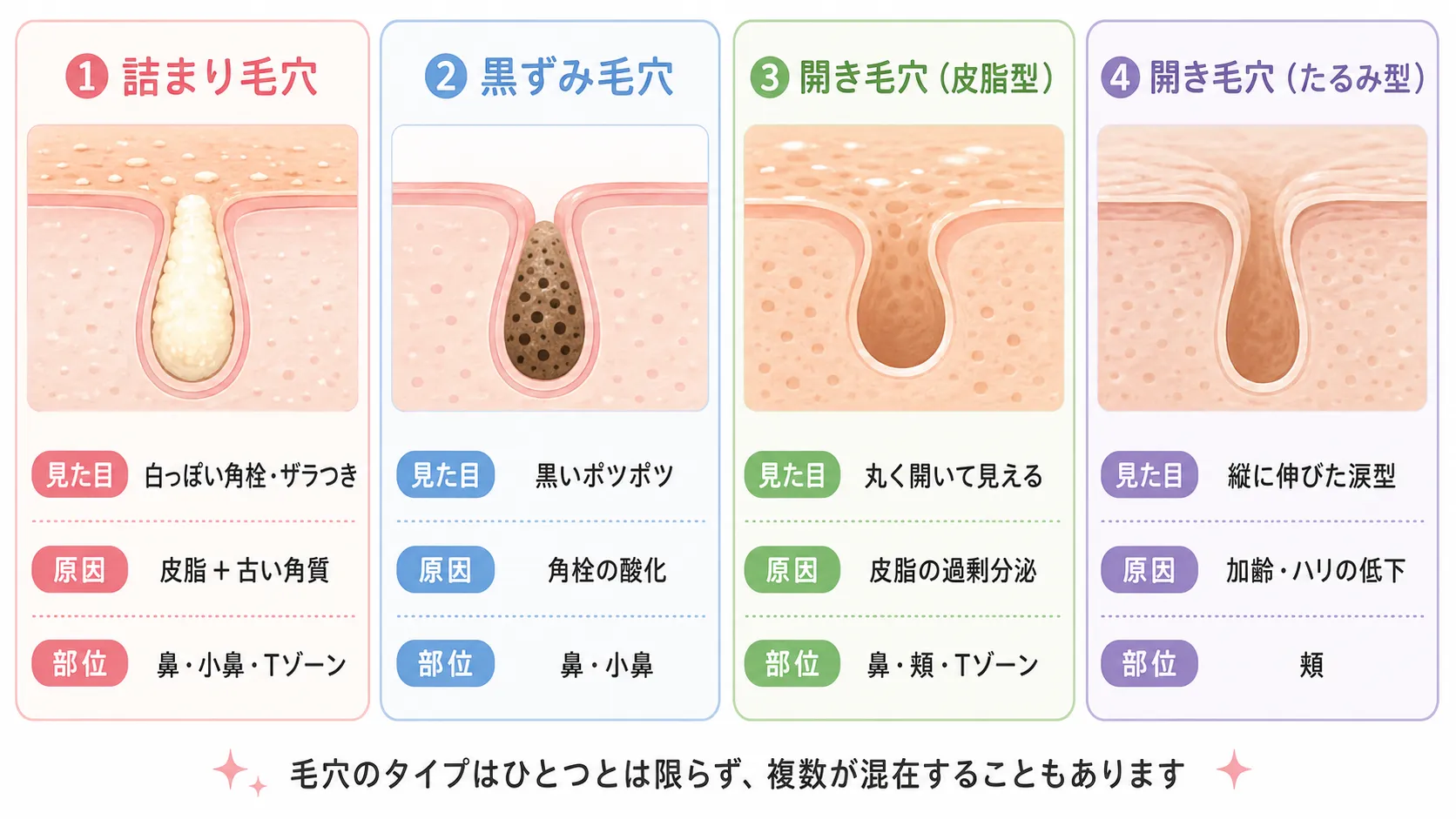 毛穴トラブルの4タイプを示す図。詰まり毛穴・黒ずみ毛穴・開き毛穴（皮脂型）・開き毛穴（たるみ型）を、見た目・原因・できやすい部位の3項目で比較。