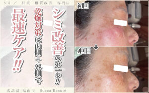 【シミ改善は乾燥対策から】福山のエステで体験する肌質＆食事ケアとは？