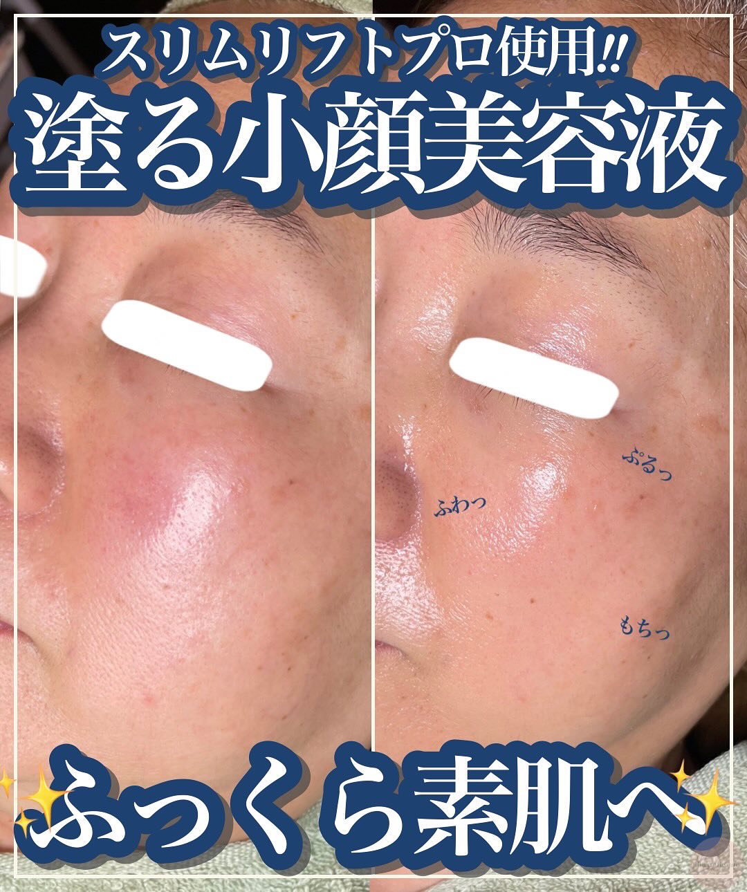 小顔になりたいあなたへ|福山で人気のエステ