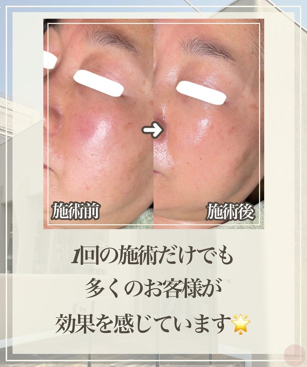 プロがすすめる!小顔に効くおすすめエステ施術