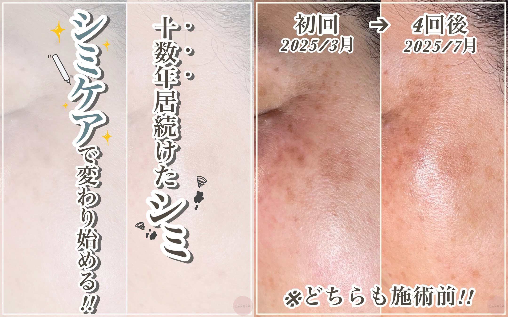 【シミは変わる】美容体質分析で導く、本気のシミケアとは？