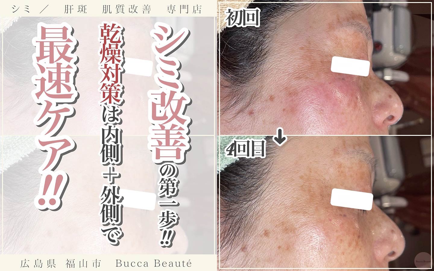 【シミは変わる】美容体質分析で導く、本気のシミケアとは？