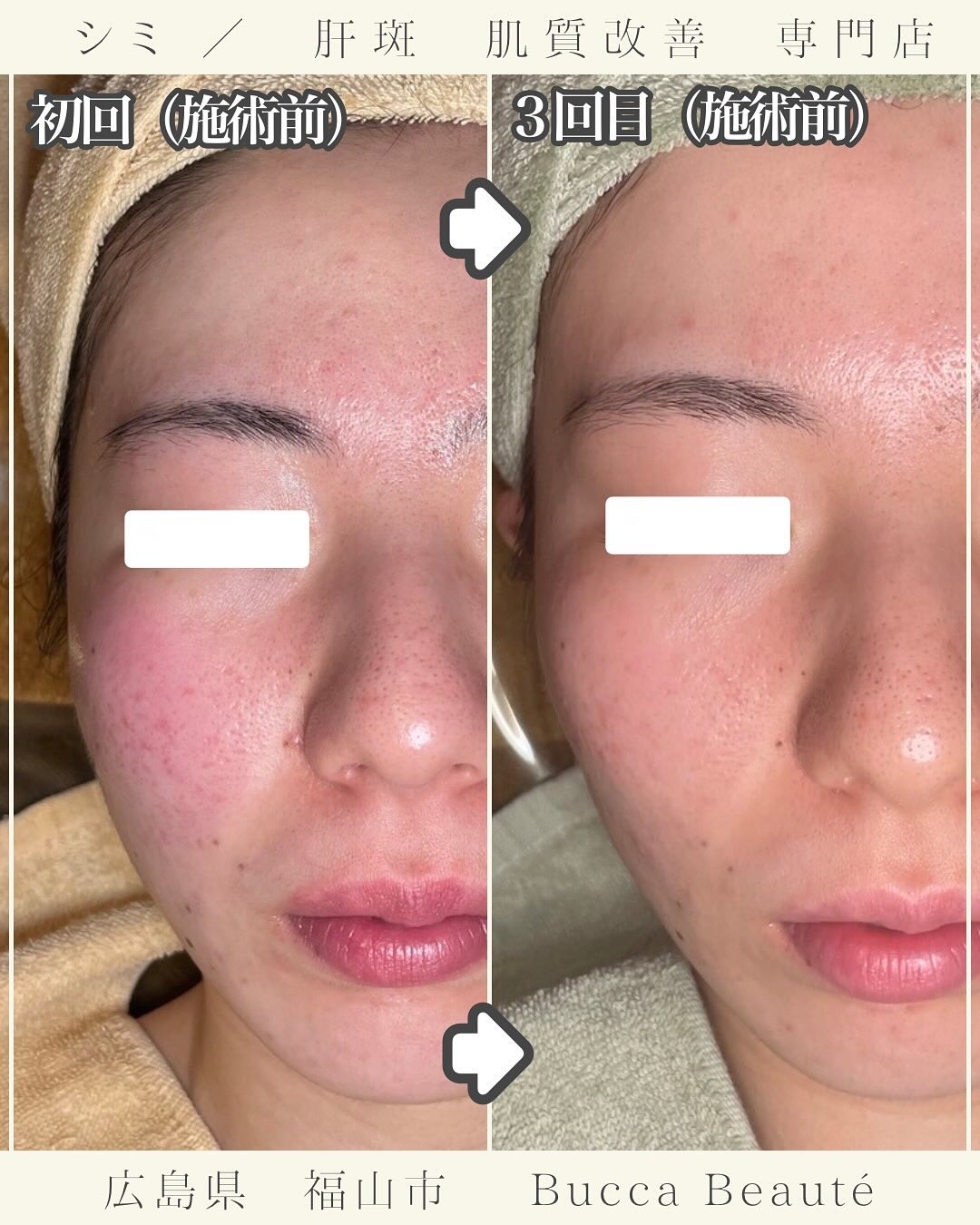 福山でお肌の赤みにお悩みの方へ|プラセンタコースで赤み改善【Bucca Beauté】