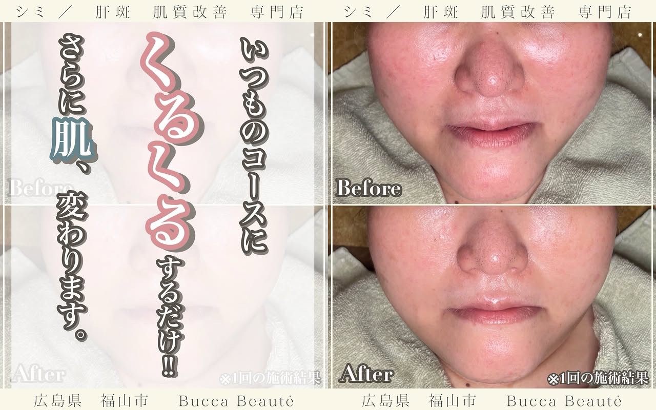 角栓まで綺麗に落とす「ホノヲヲクレンジング」で叶える透明美肌 | 福山市Bucca Beauté