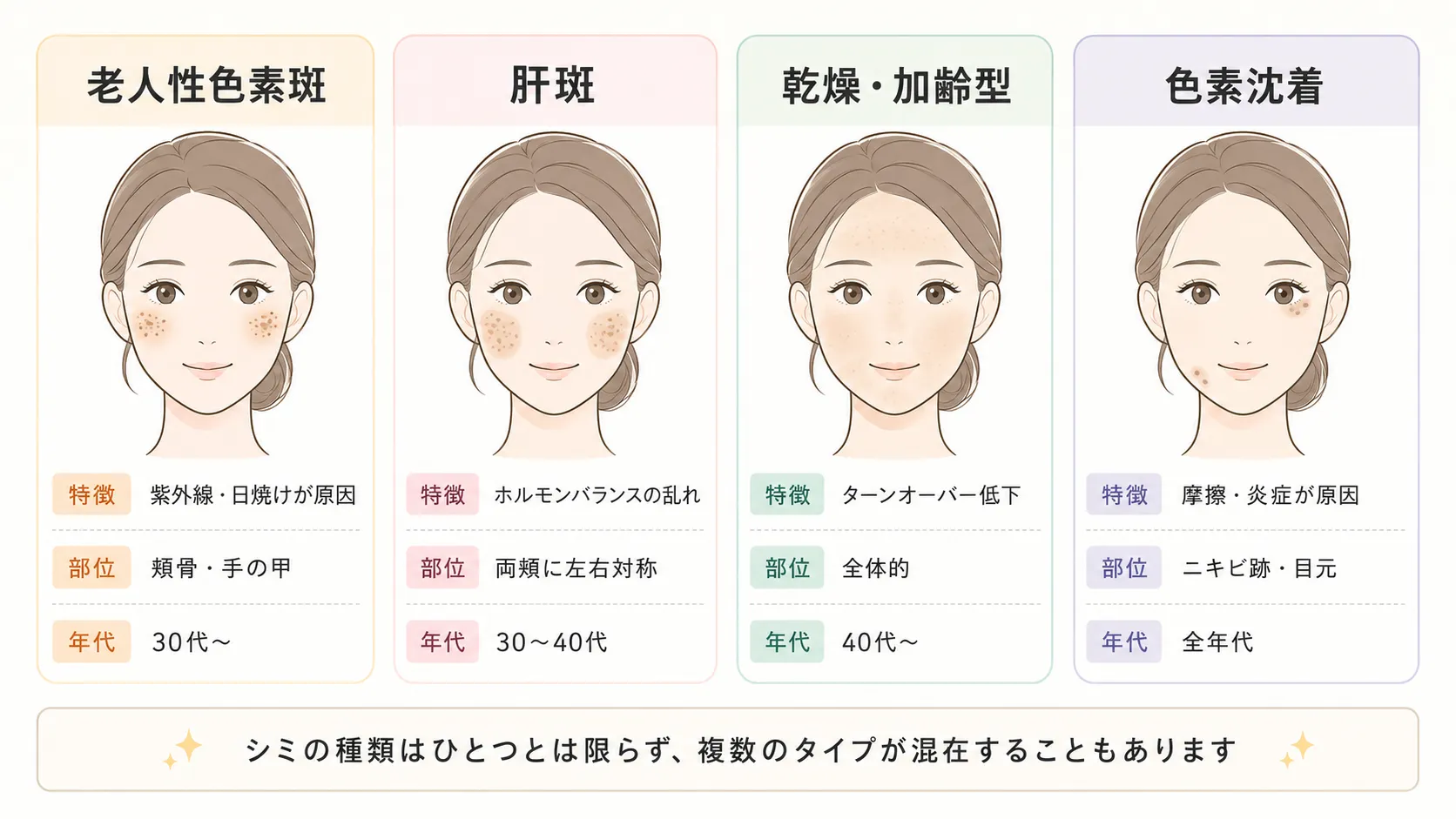 シミの4タイプを示す図。老人性色素斑・肝斑・乾燥加齢型・色素沈着を、特徴・できやすい部位・多い年代の3項目で比較。